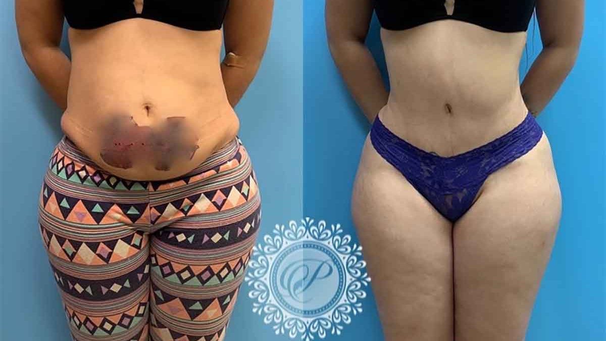 27 Woman After Tummy Tuck w Lipo 360 | Petrungaro Plastic Surgery