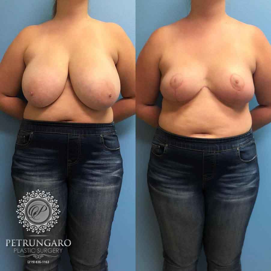 20-breast-reduction-1
