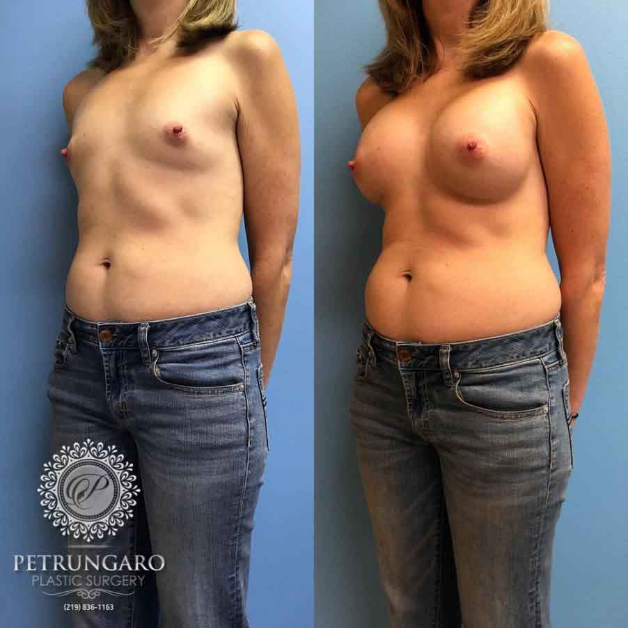 20-breast-reduction-5-1