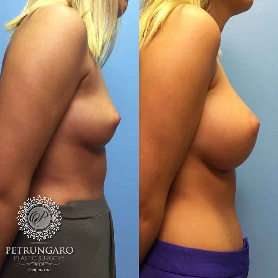 21-before-after-breast-augmentation-implants-1-1