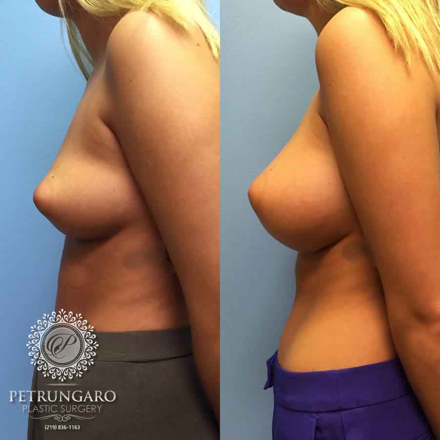 21-before-after-breast-augmentation-implants-2-1