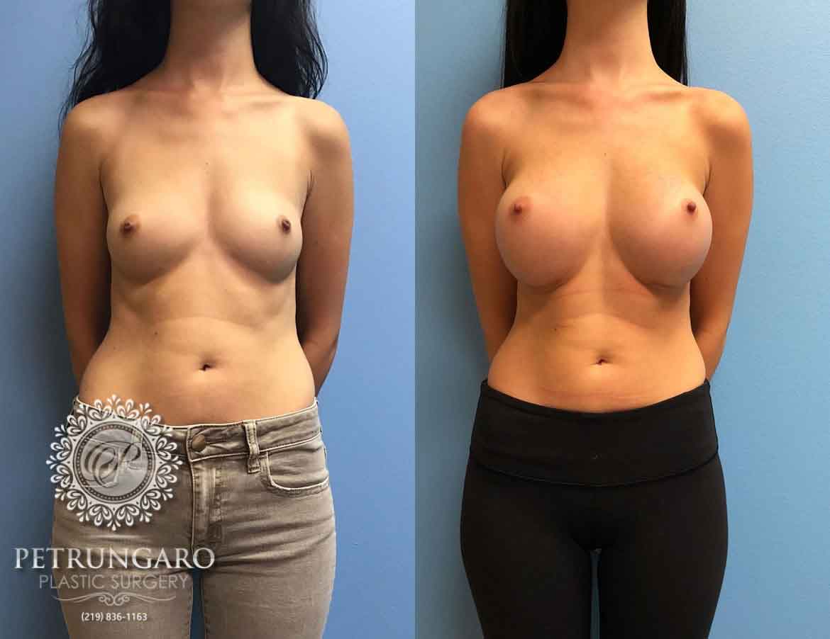 24-female-breast-augmentation-1
