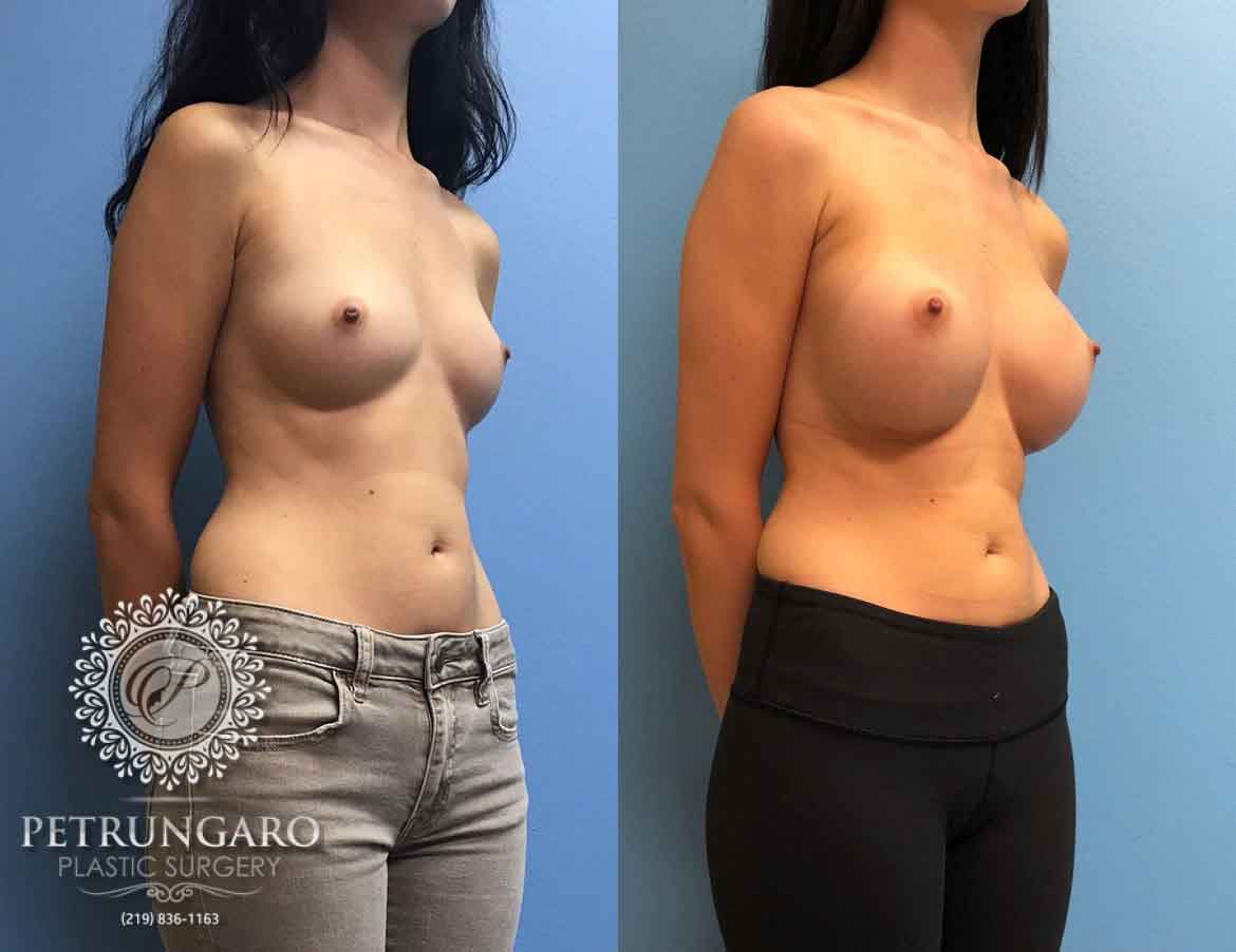 24-female-breast-augmentation-3