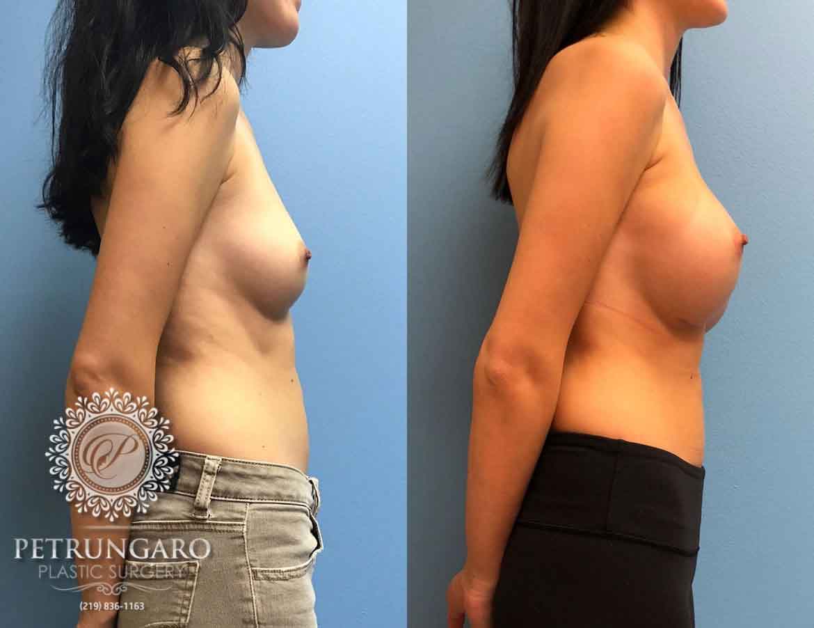 24-female-breast-augmentation-4