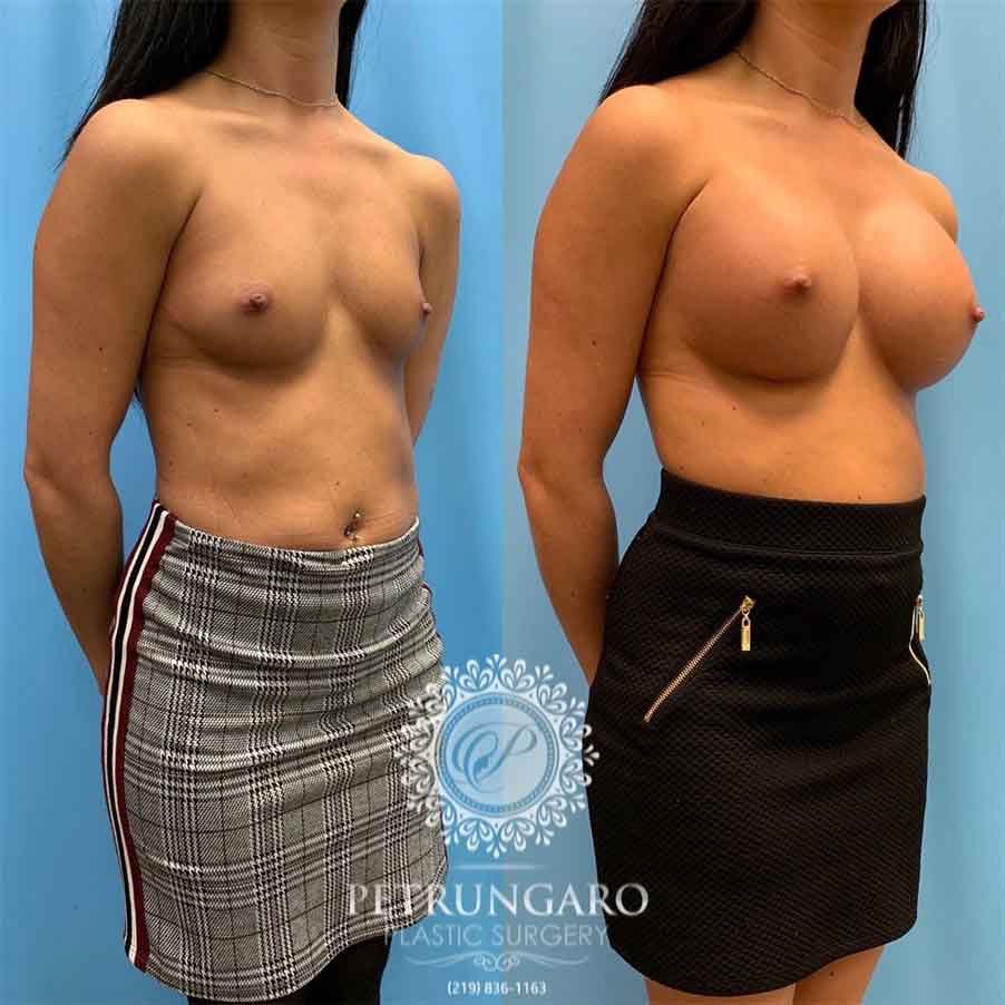 26-before-after-photo-breast-augmentation-4