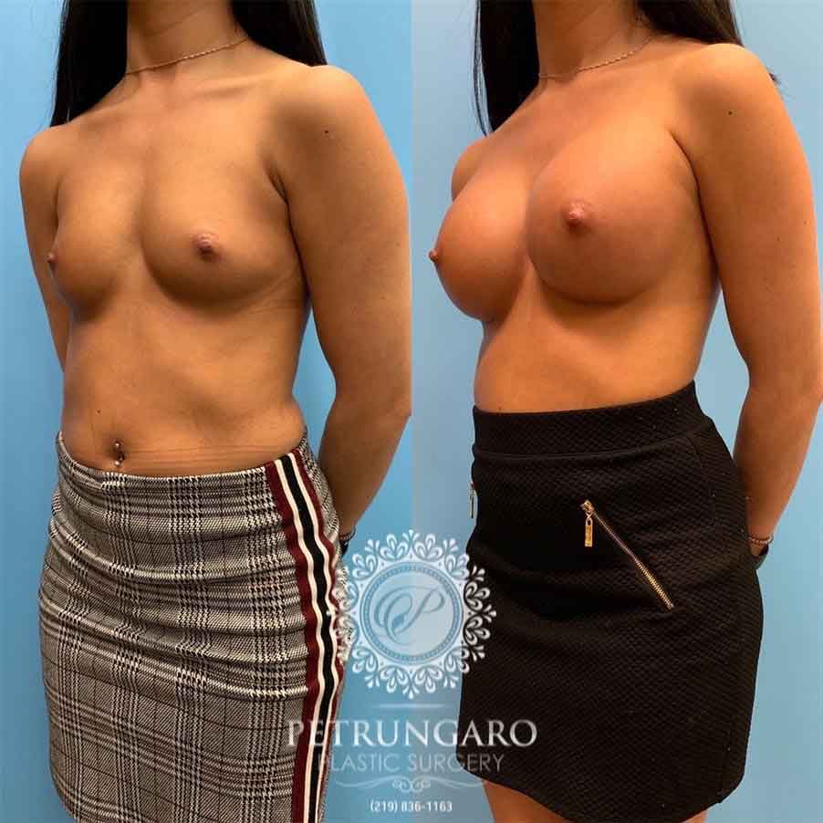 26-before-after-photo-breast-augmentation-5