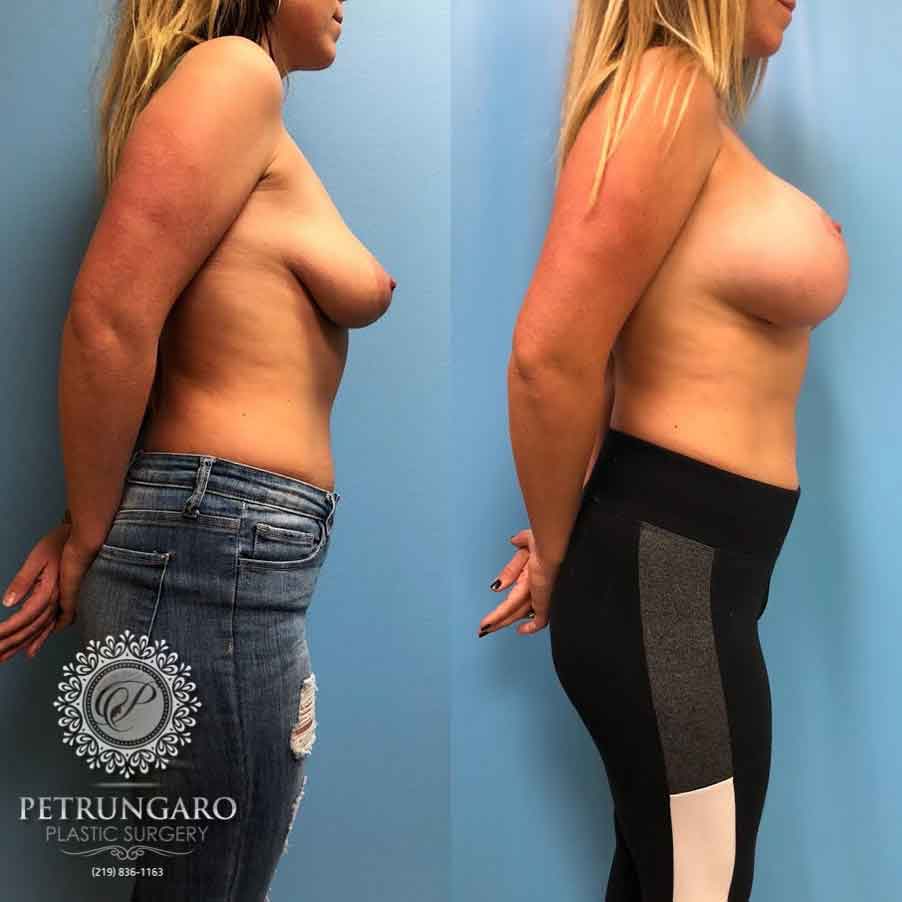 26-breast-lift-with-implants-3
