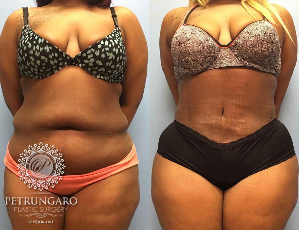 26-year-old-woman-3-months-after-Tummy-Tuck-Lipo-360-1a