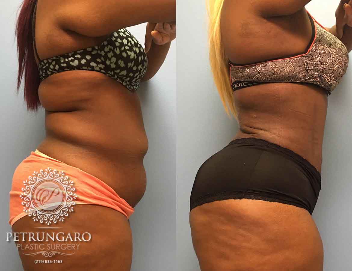 26-year-old-woman-3-months-after-Tummy-Tuck-Lipo-360-2a
