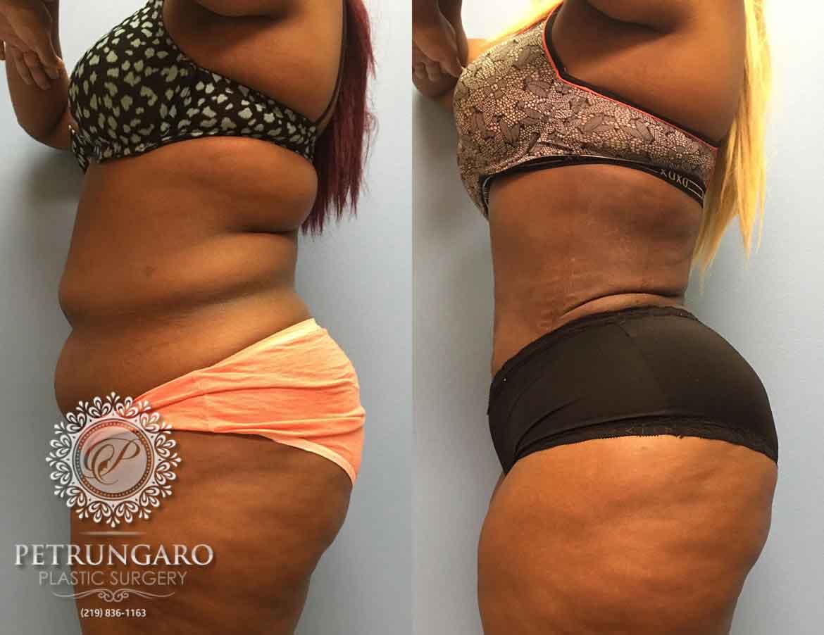 26-year-old-woman-3-months-after-Tummy-Tuck-Lipo-360-3a