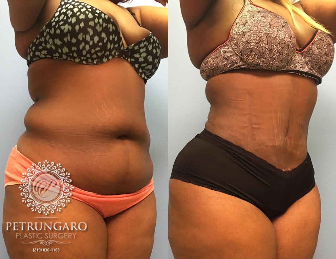 26-year-old-woman-3-months-after-Tummy-Tuck-Lipo-360-4a@2x