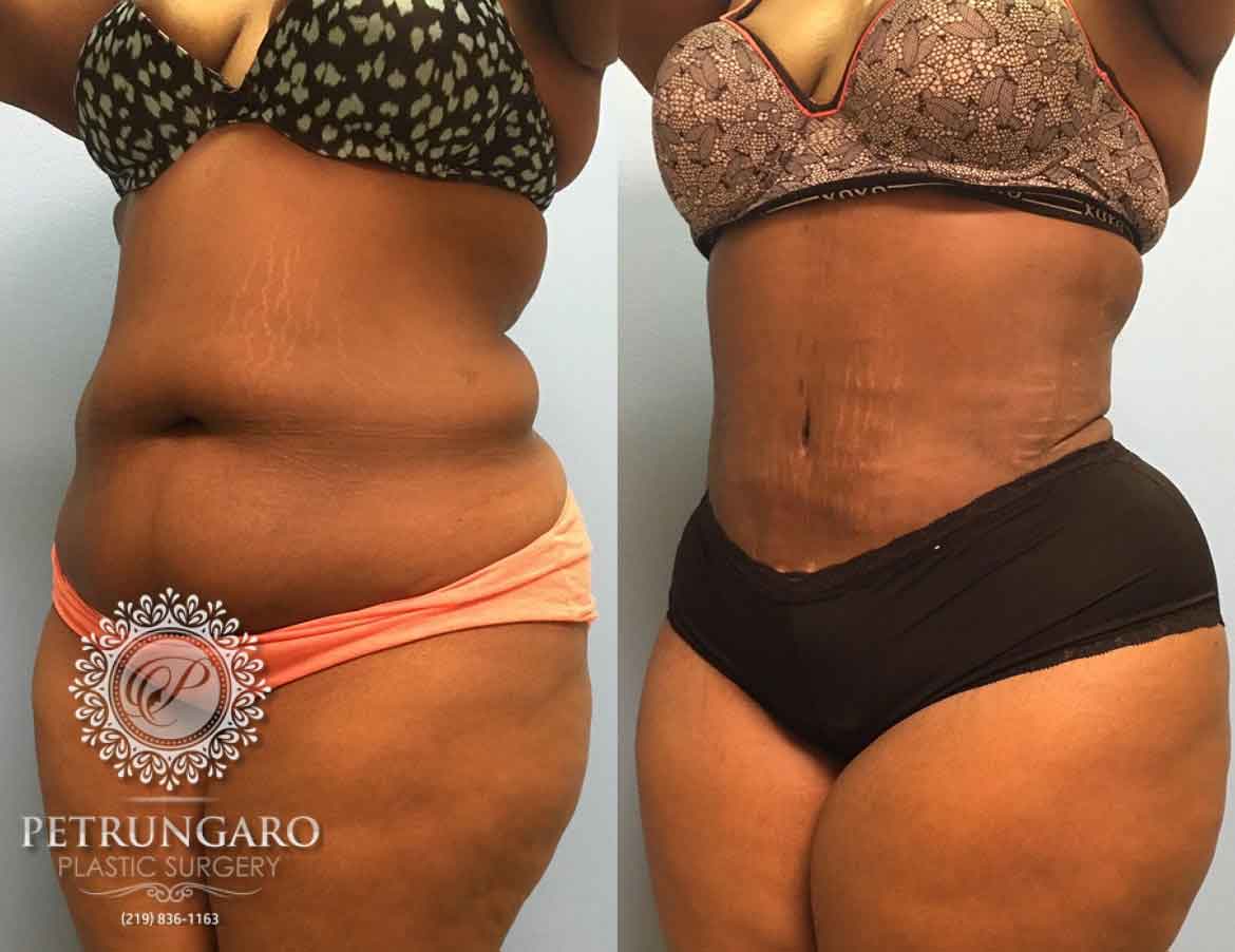 26-year-old-woman-3-months-after-Tummy-Tuck-Lipo-360-5a