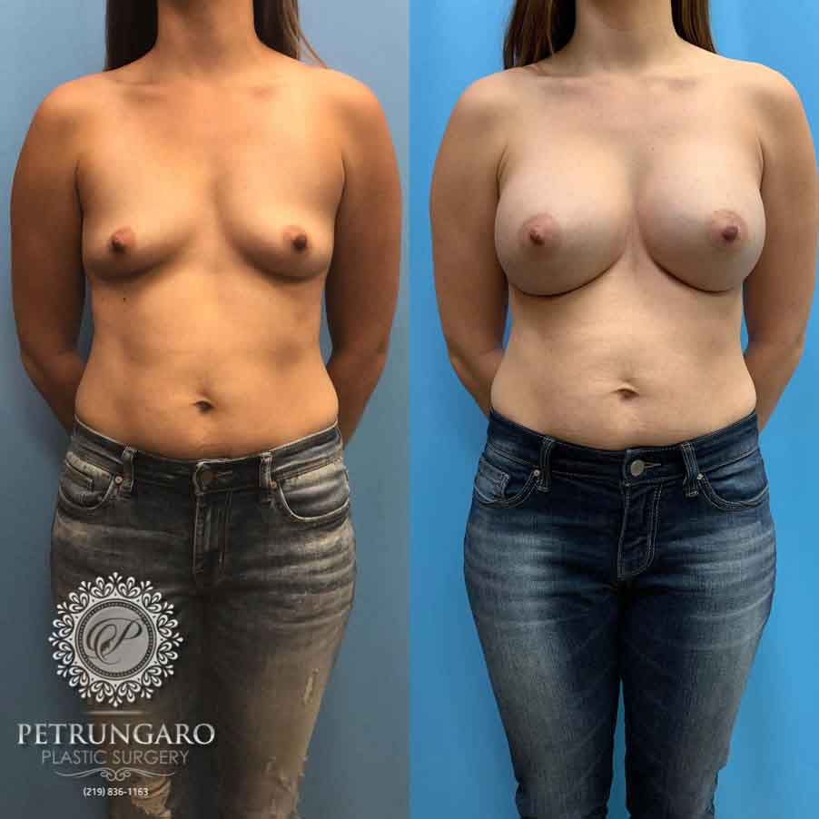 28-before-after-breast-augmentation-implants-5