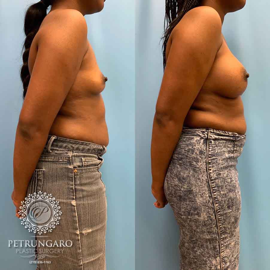 28-before-after-breast-augmerntation-3
