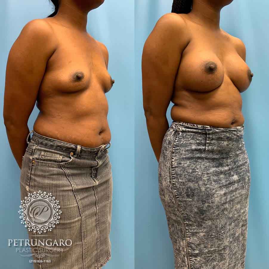 28-before-after-breast-augmerntation-4