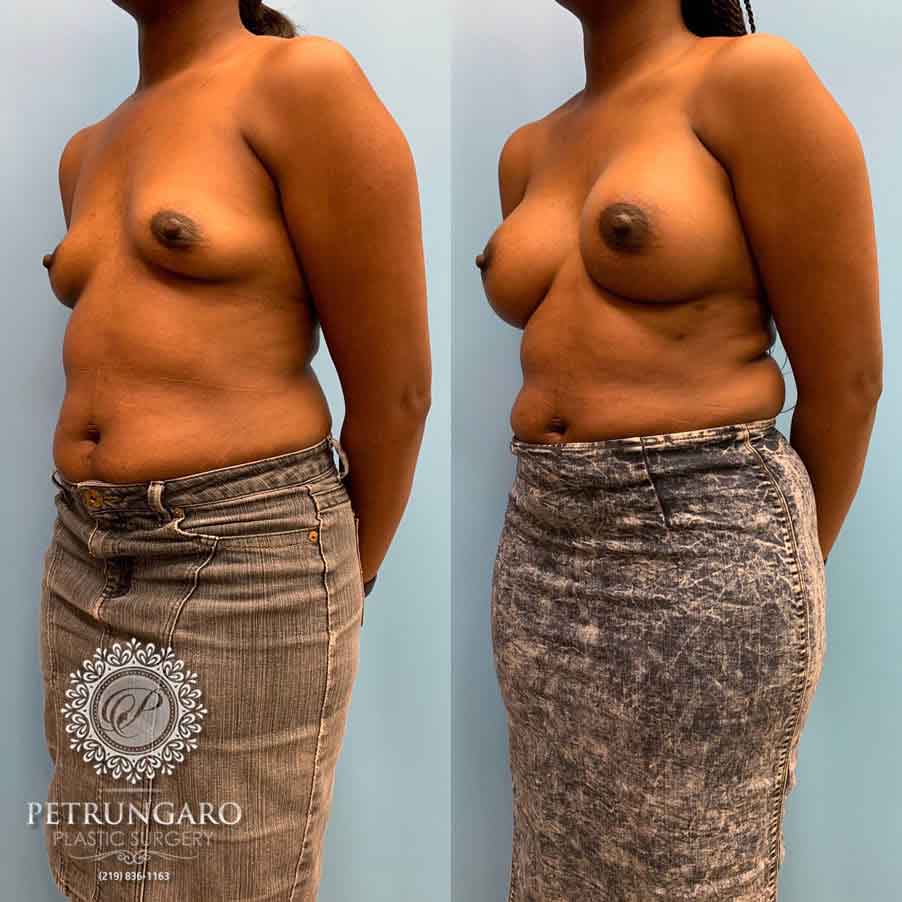 28-before-after-breast-augmerntation-5