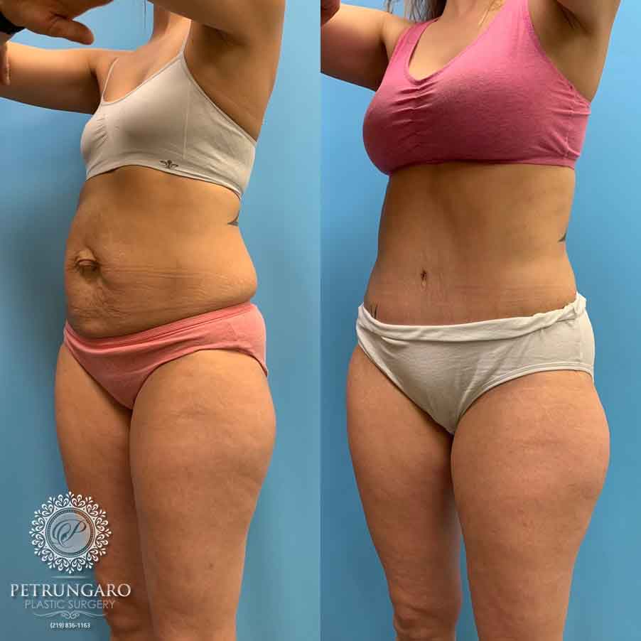 29-before-after-tummy-tuck-lipo-360-1