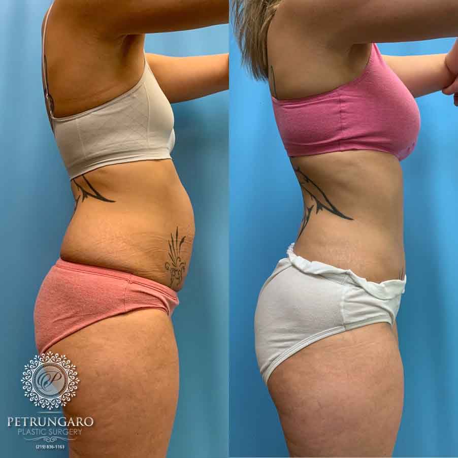 29-before-after-tummy-tuck-lipo-360-3