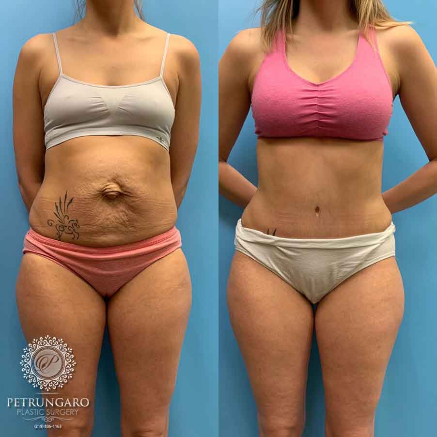 29-before-after-tummy-tuck-lipo-360-5