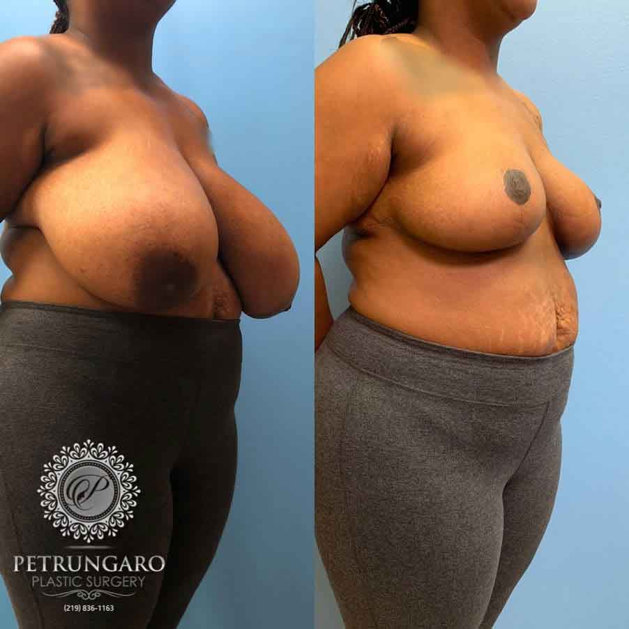 29-breast-reduction-nw-indiana-1