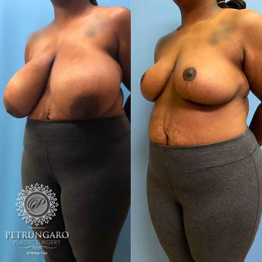29-breast-reduction-nw-indiana-2
