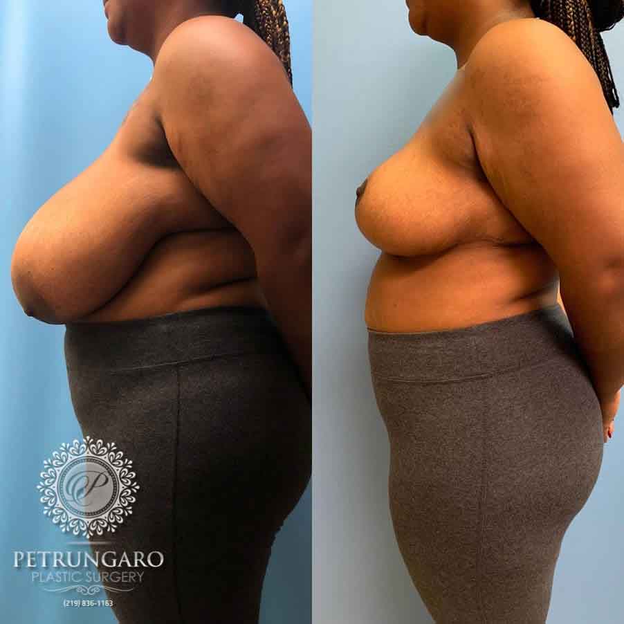 29-breast-reduction-nw-indiana-4