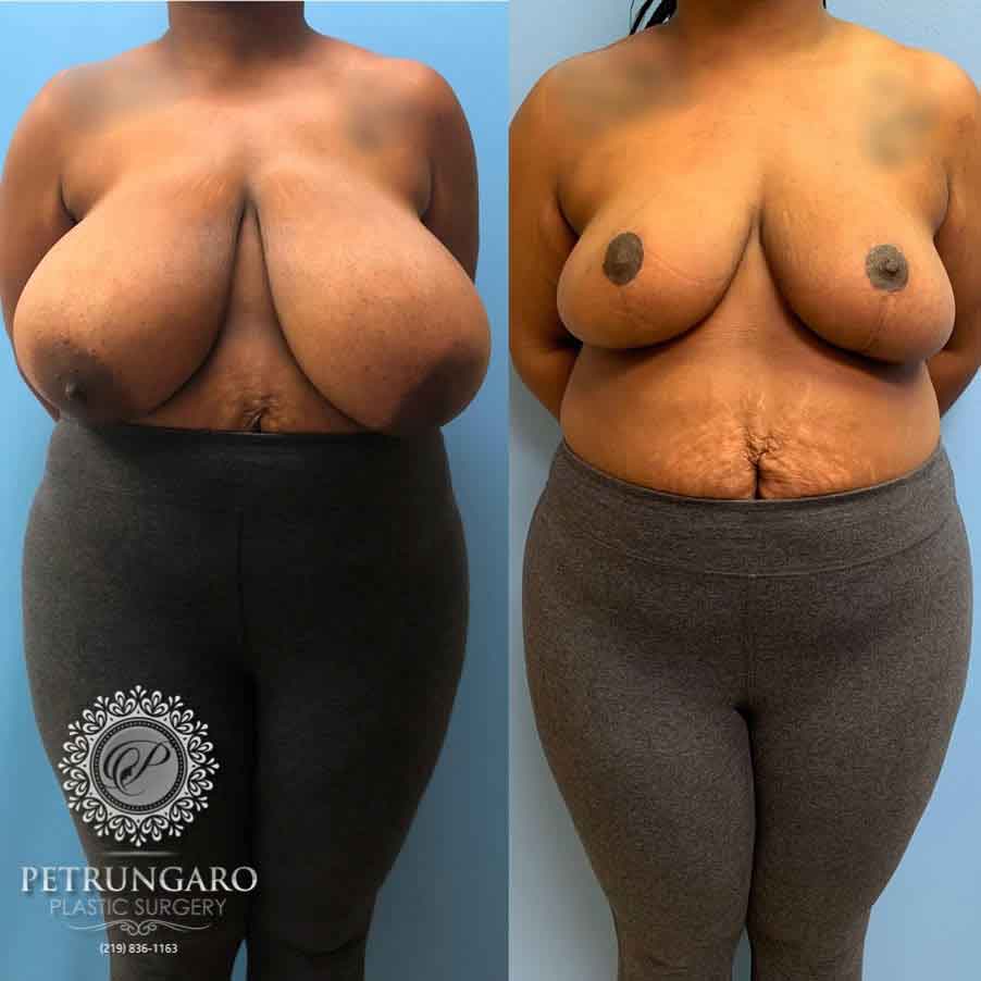 29-breast-reduction-nw-indiana-5