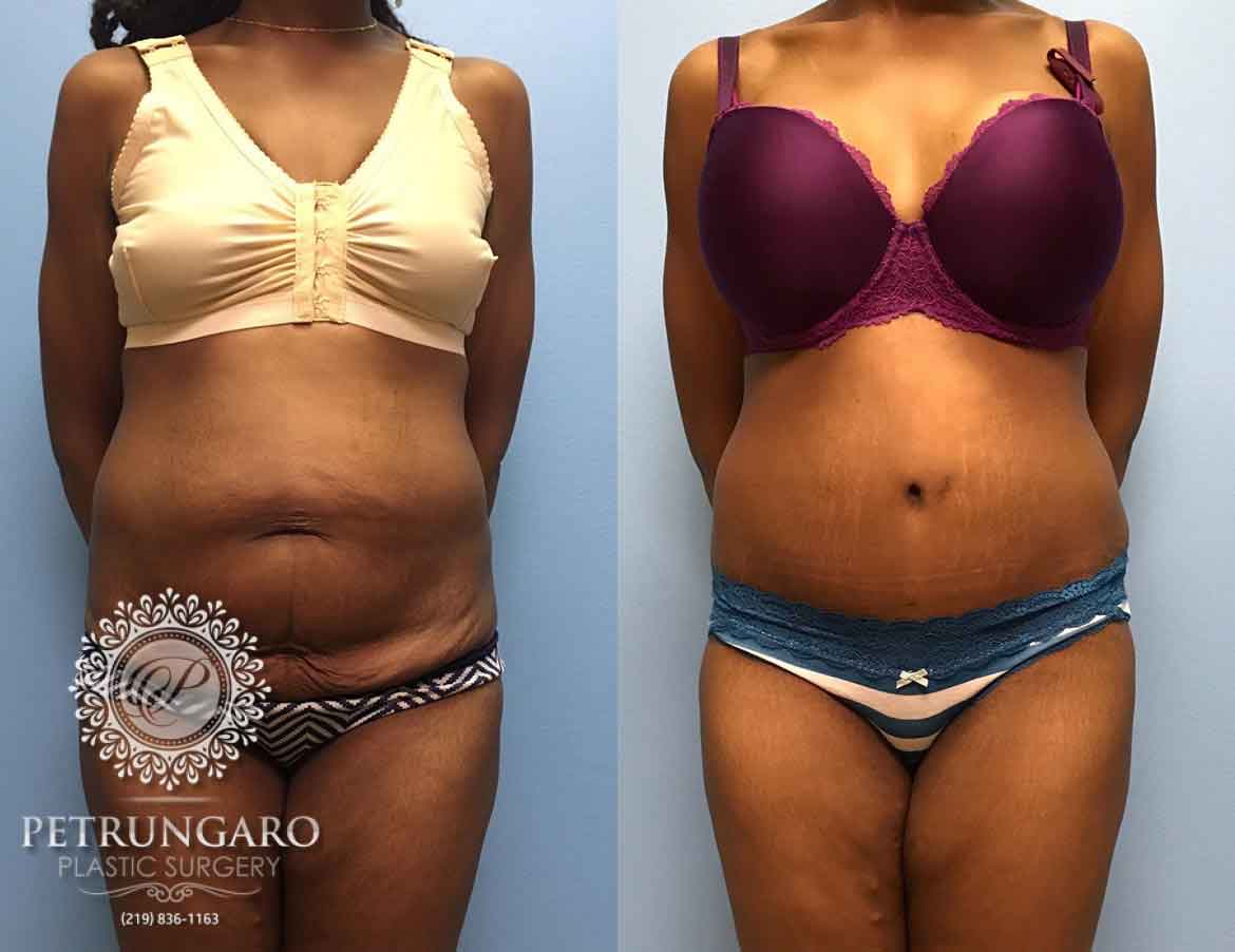 31-year-old-woman-3-months-after-Tummy-Tuck-1