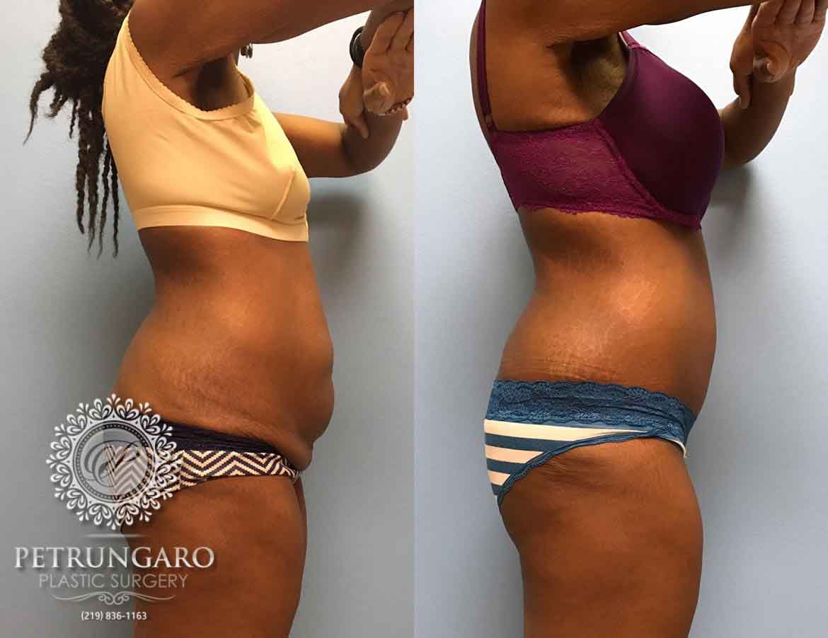 31-year-old-woman-3-months-after-Tummy-Tuck-2