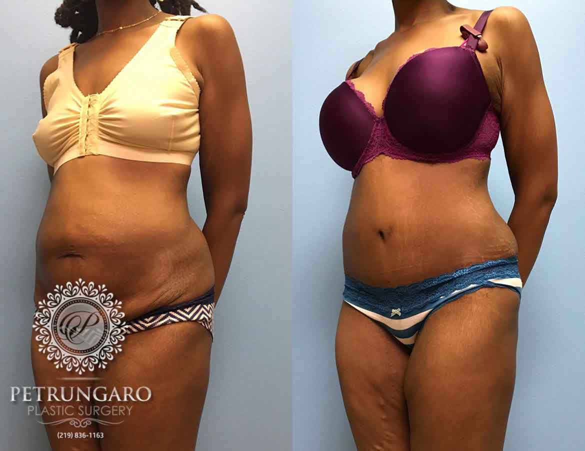 31-year-old-woman-3-months-after-Tummy-Tuck-4