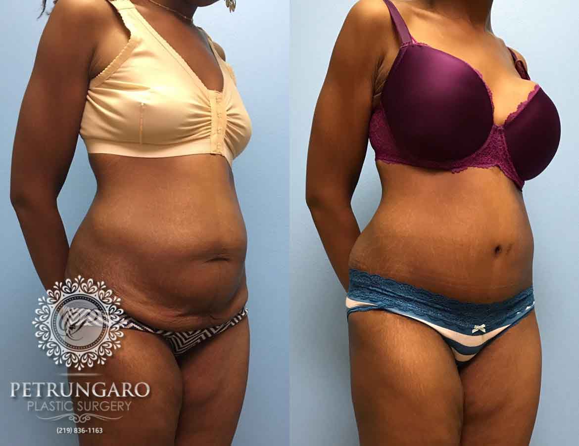 31-year-old-woman-3-months-after-Tummy-Tuck-5