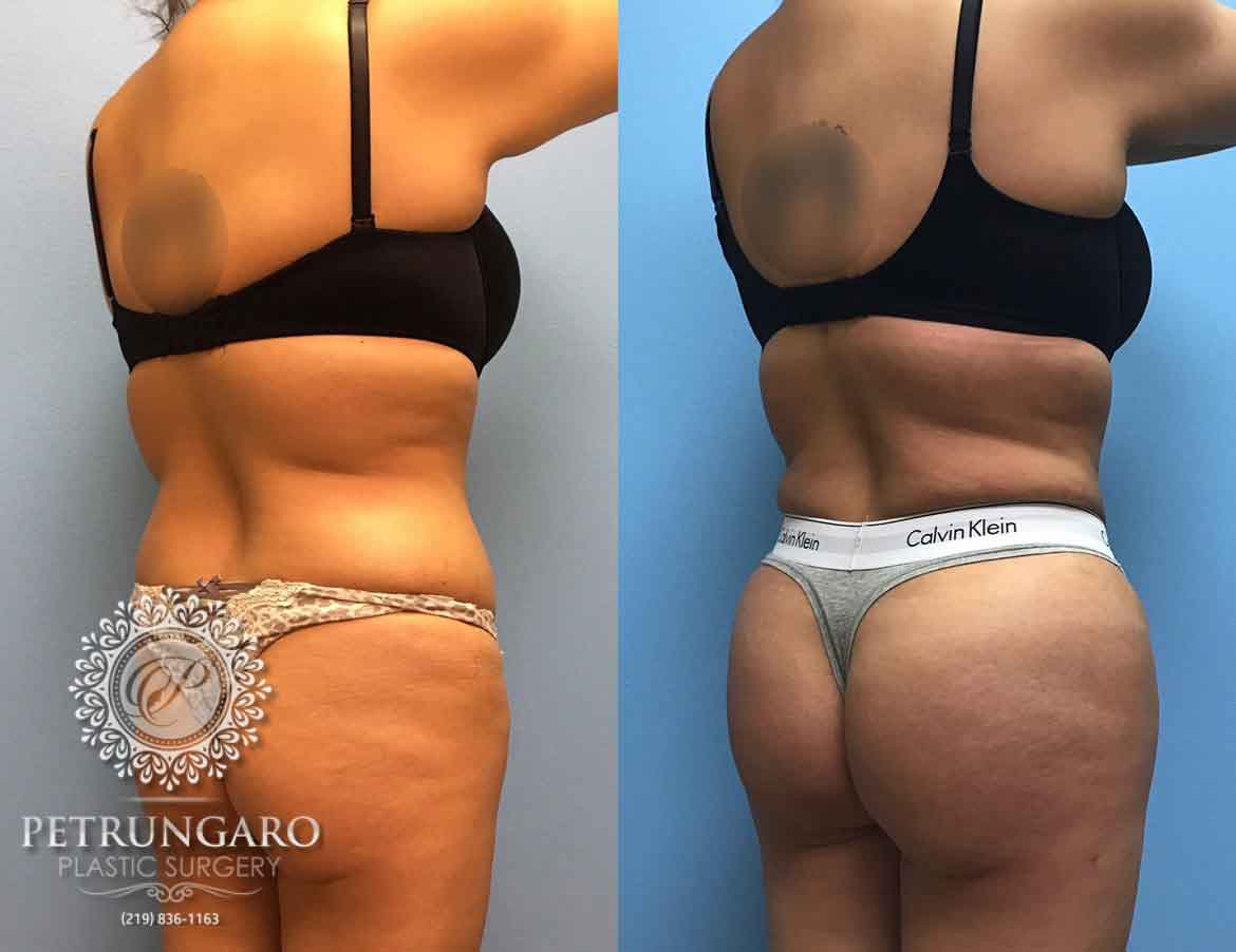 32-yr-old-woman-3-months-after-Brazilian-Butt-Lift-1