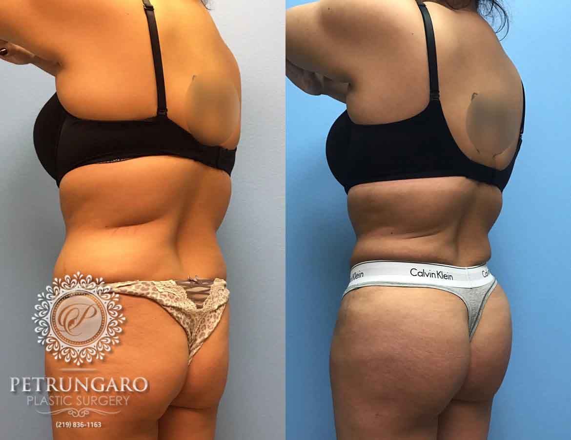 32-yr-old-woman-3-months-after-Brazilian-Butt-Lift-2
