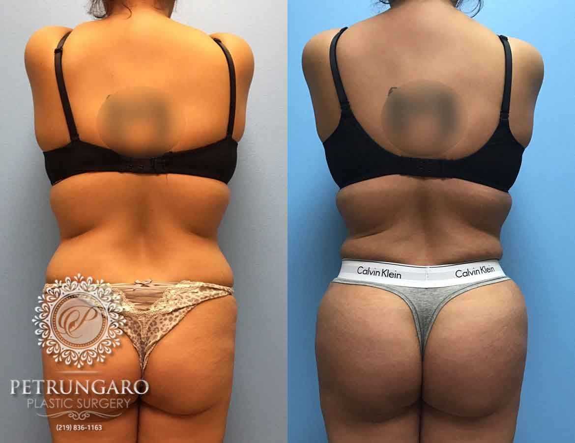 32-yr-old-woman-3-months-after-Brazilian-Butt-Lift-5