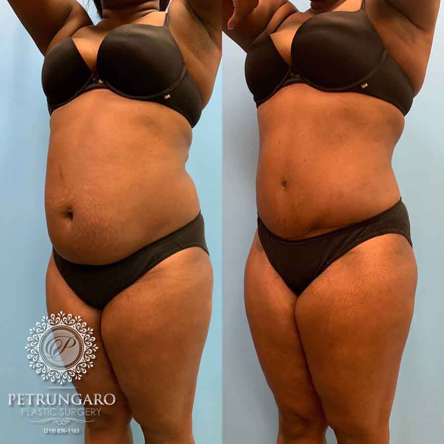 33-before-after-tummy-tuck-lipo-360-1