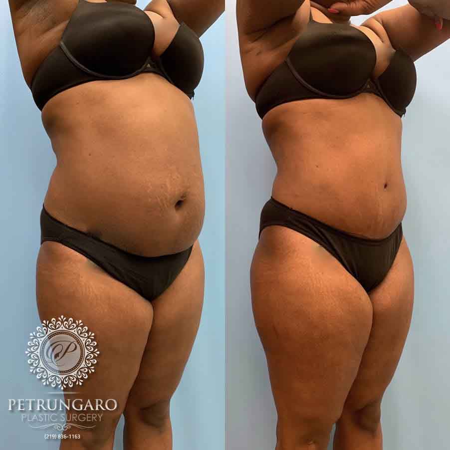 33-before-after-tummy-tuck-lipo-360-2