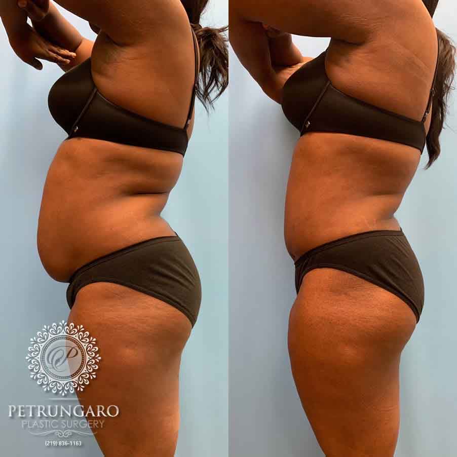 33-before-after-tummy-tuck-lipo-360-3