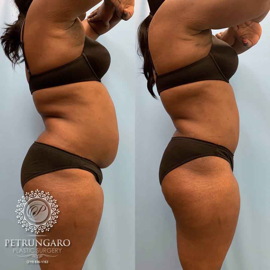 33-before-after-tummy-tuck-lipo-360-4