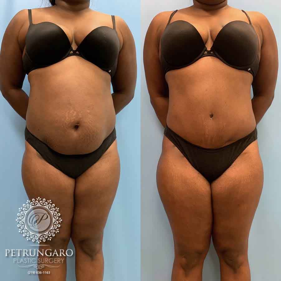 33-before-after-tummy-tuck-lipo-360-5