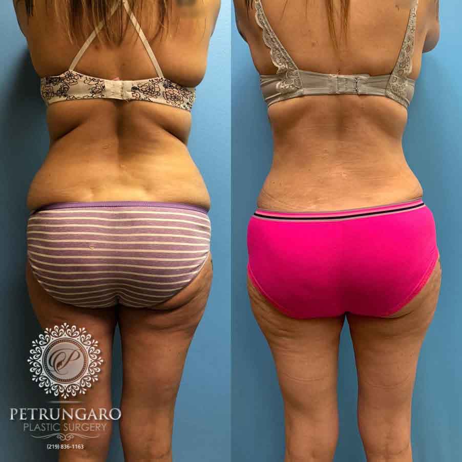35-before-after-tummy-tuck-lipo-360-1