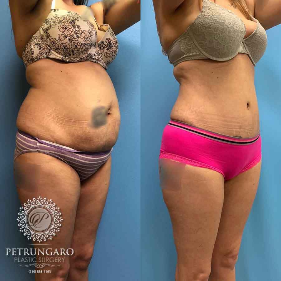 35-before-after-tummy-tuck-lipo-360-2
