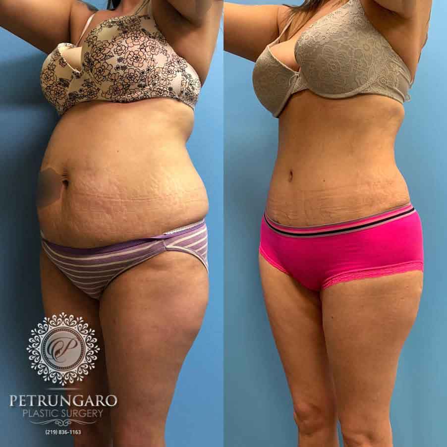 35 F After Tummy Tuck With Lipo 360 Petrungaro Plastic Surgery.