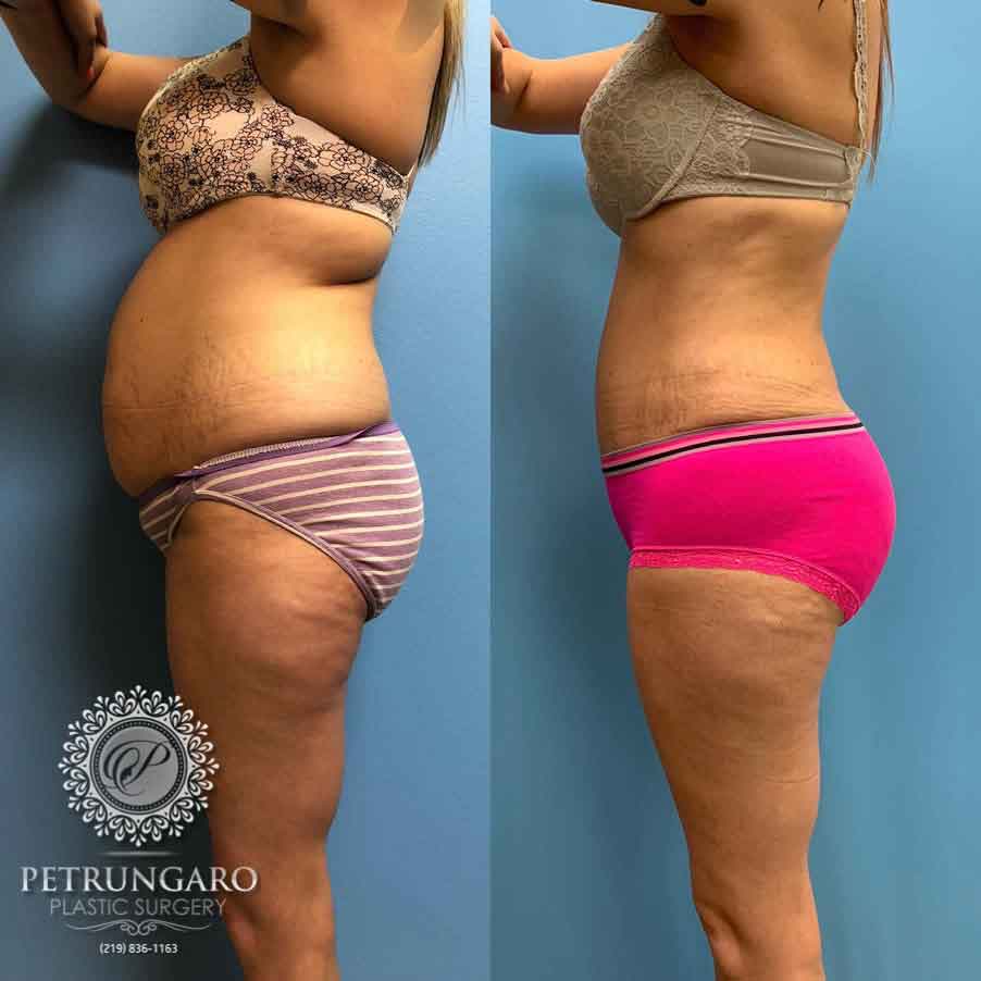 35-before-after-tummy-tuck-lipo-360-4