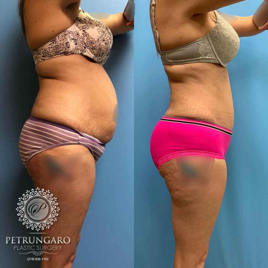 35-before-after-tummy-tuck-lipo-360-5
