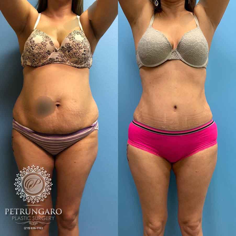 35-before-after-tummy-tuck-lipo-360-6