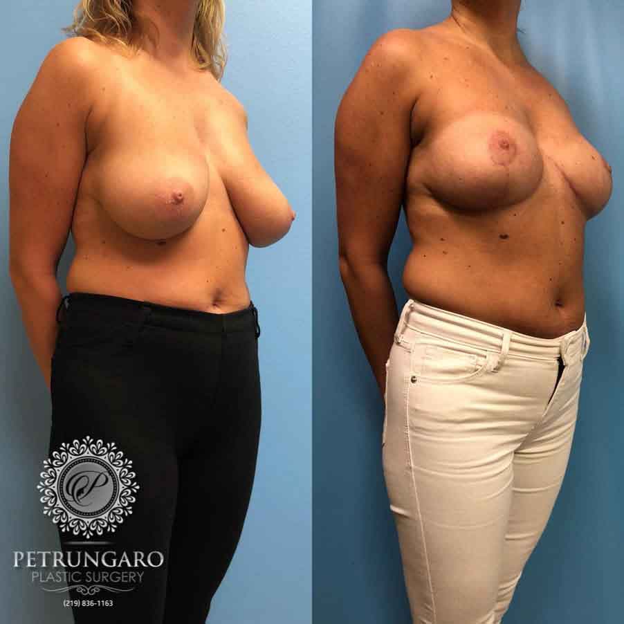 36-before-after-breast-lift-1