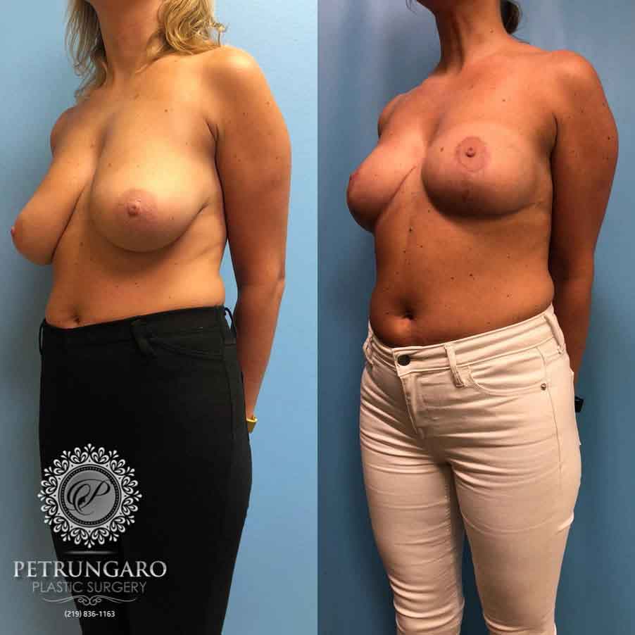 36-before-after-breast-lift-2