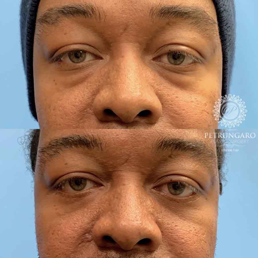 36-before-after-photo-lower-eyelid-lift-1