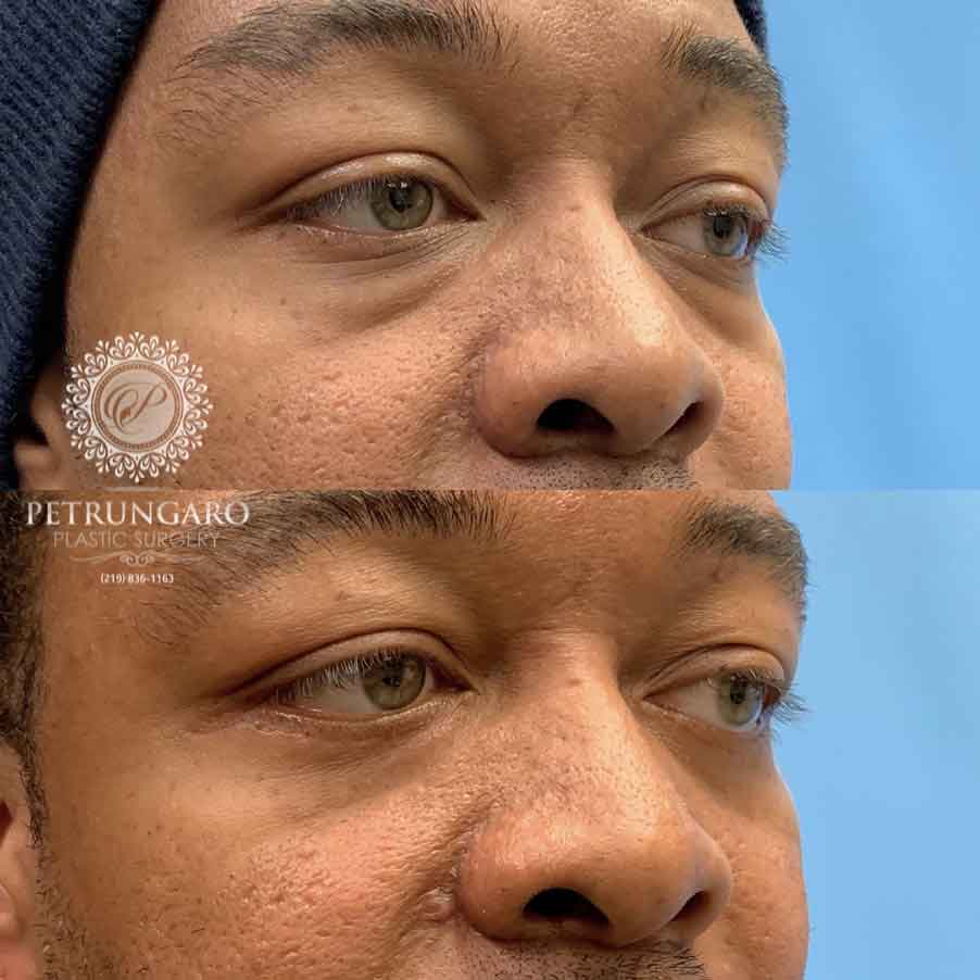 36-before-after-photo-lower-eyelid-lift-4