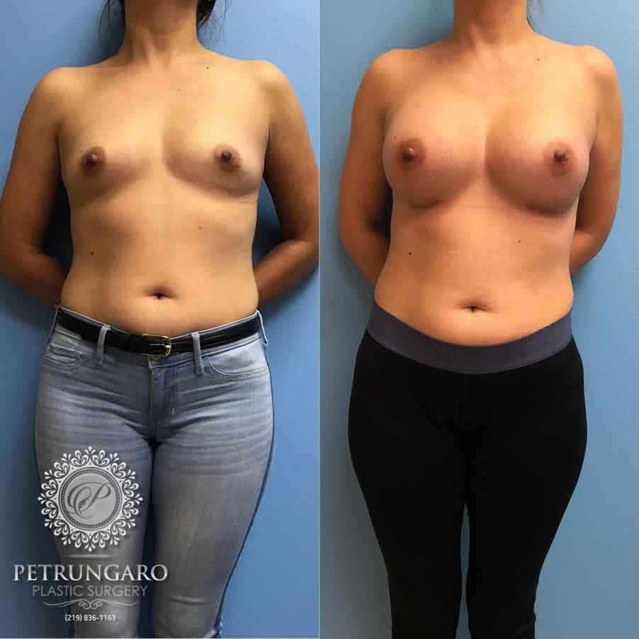 36 F After Breast Augmentation | Petrungaro Plastic Surgery
